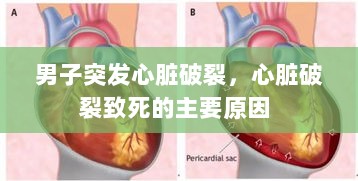 男子突发心脏破裂，心脏破裂致死的主要原因 